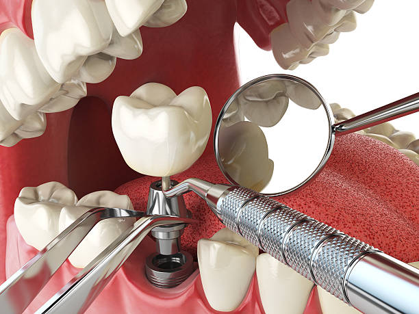 Best Emergency Wisdom Tooth Extraction in Portage, MI